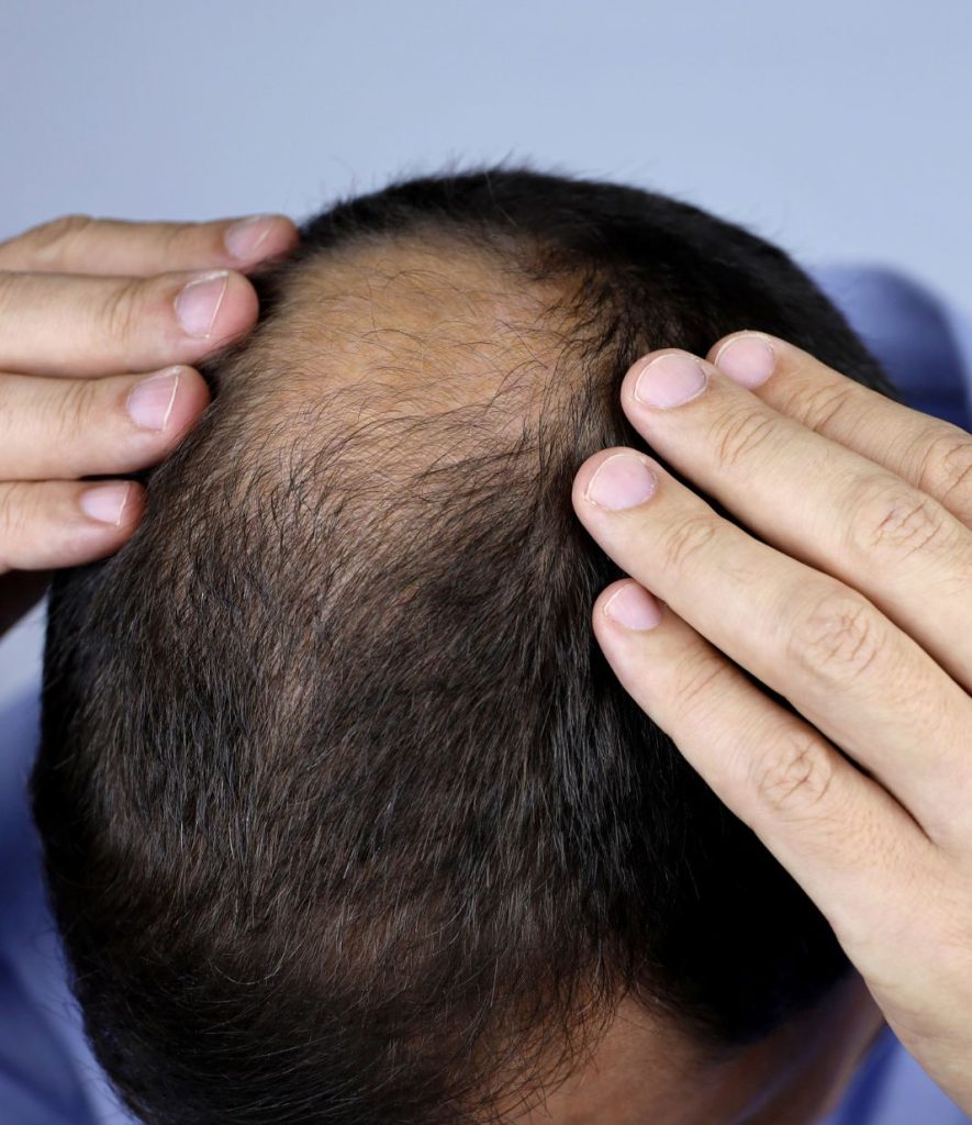 natural ways to treat hair loss